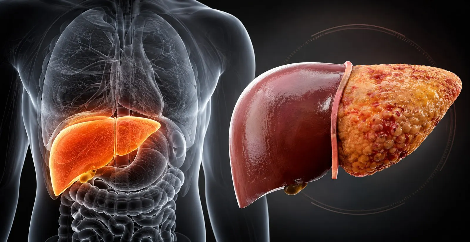 Comparação entre fígado saudável e fígado com esteatose hepática